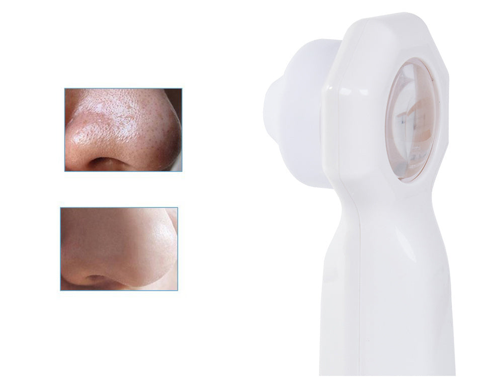 Juodagalvių ir spuogų siurblys paskatino didintuvą