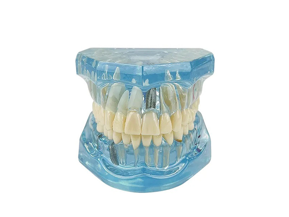 Dantų modelis žandikaulio dantys dantų implantai