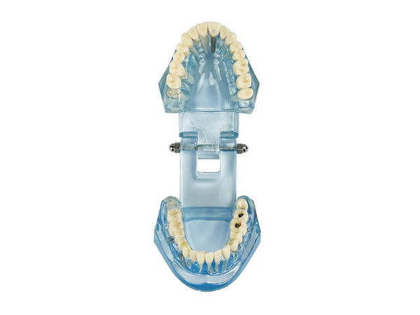 Dantų modelis žandikaulio dantys dantų implantai