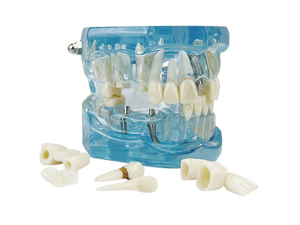 Dantų modelis žandikaulio dantys dantų implantai
